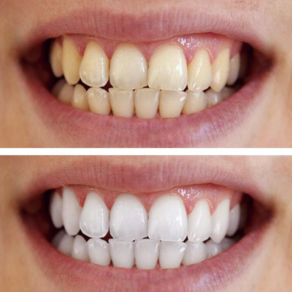A before-and-after comparison of teeth shade